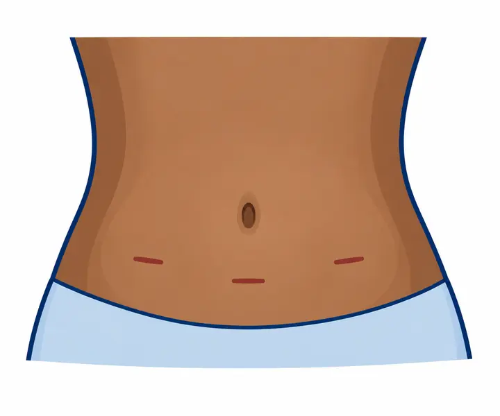 Illustration of three small abdominal incisions