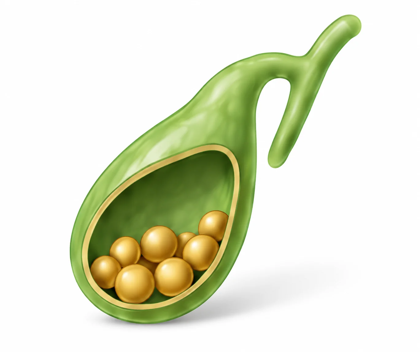 Cutaway illustration of the pear-shaped gallbladder containing gallstones.