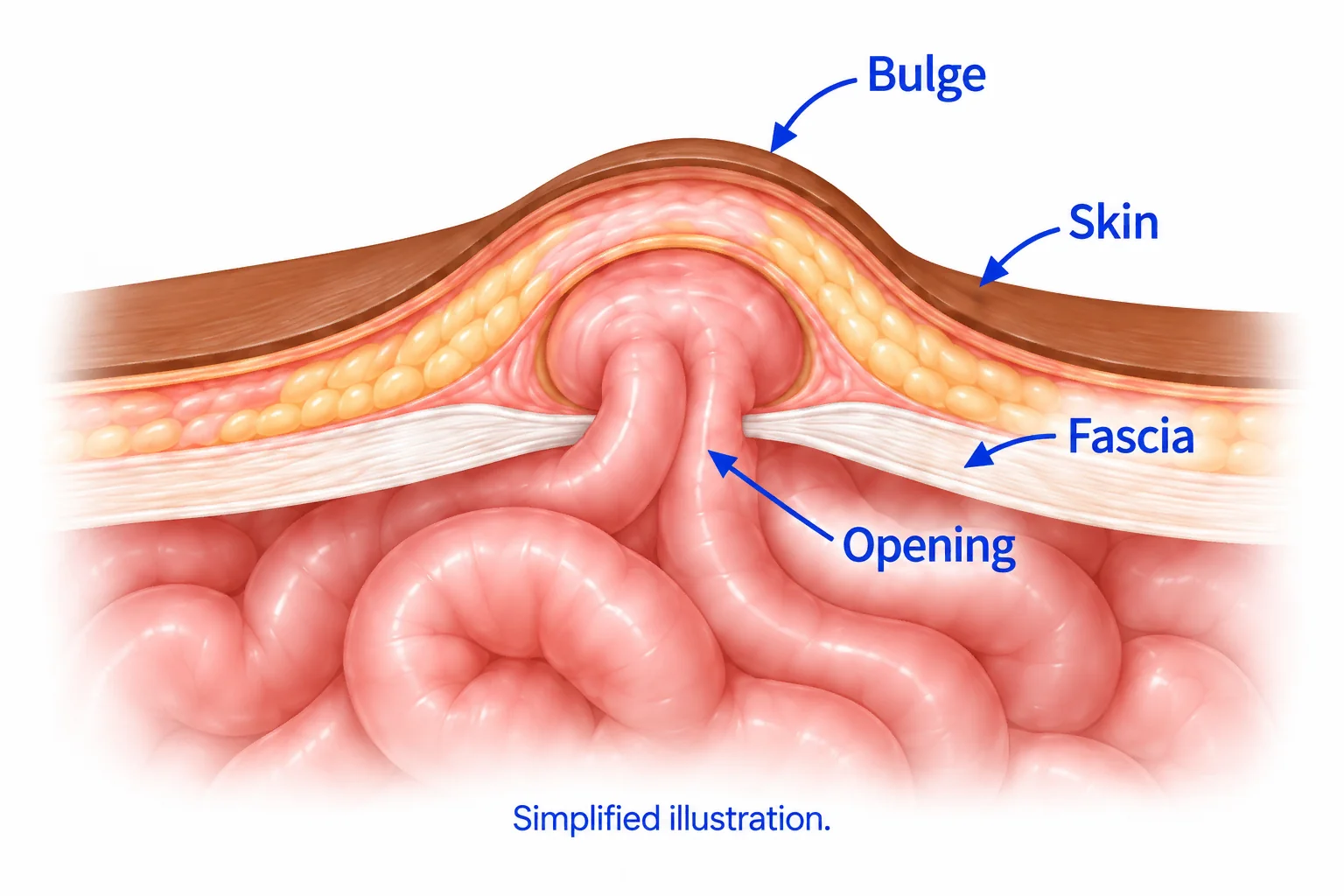 Simplified cross-section showing intestine pushing through an opening in the fascia, the strong supporting layer beneath the skin, creating a bulge. Labels identify the bulge, skin, fascia, and opening.