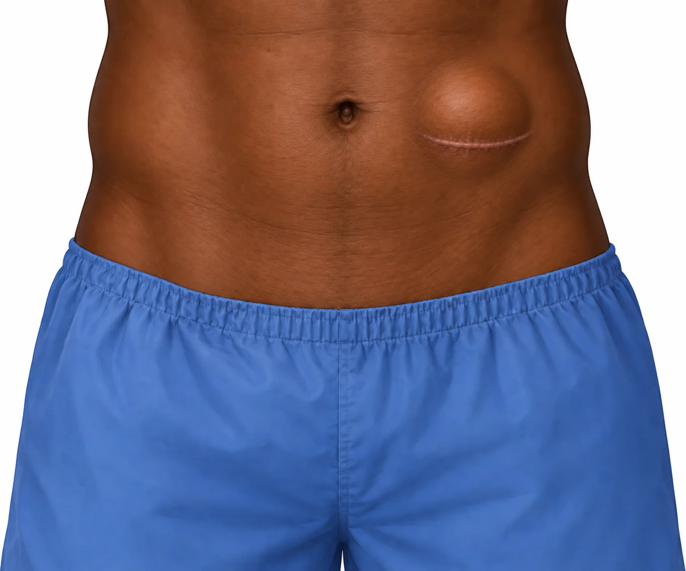 Illustration of an incisional hernia with a bulge at and above a healed horizontal scar on the left abdomen.