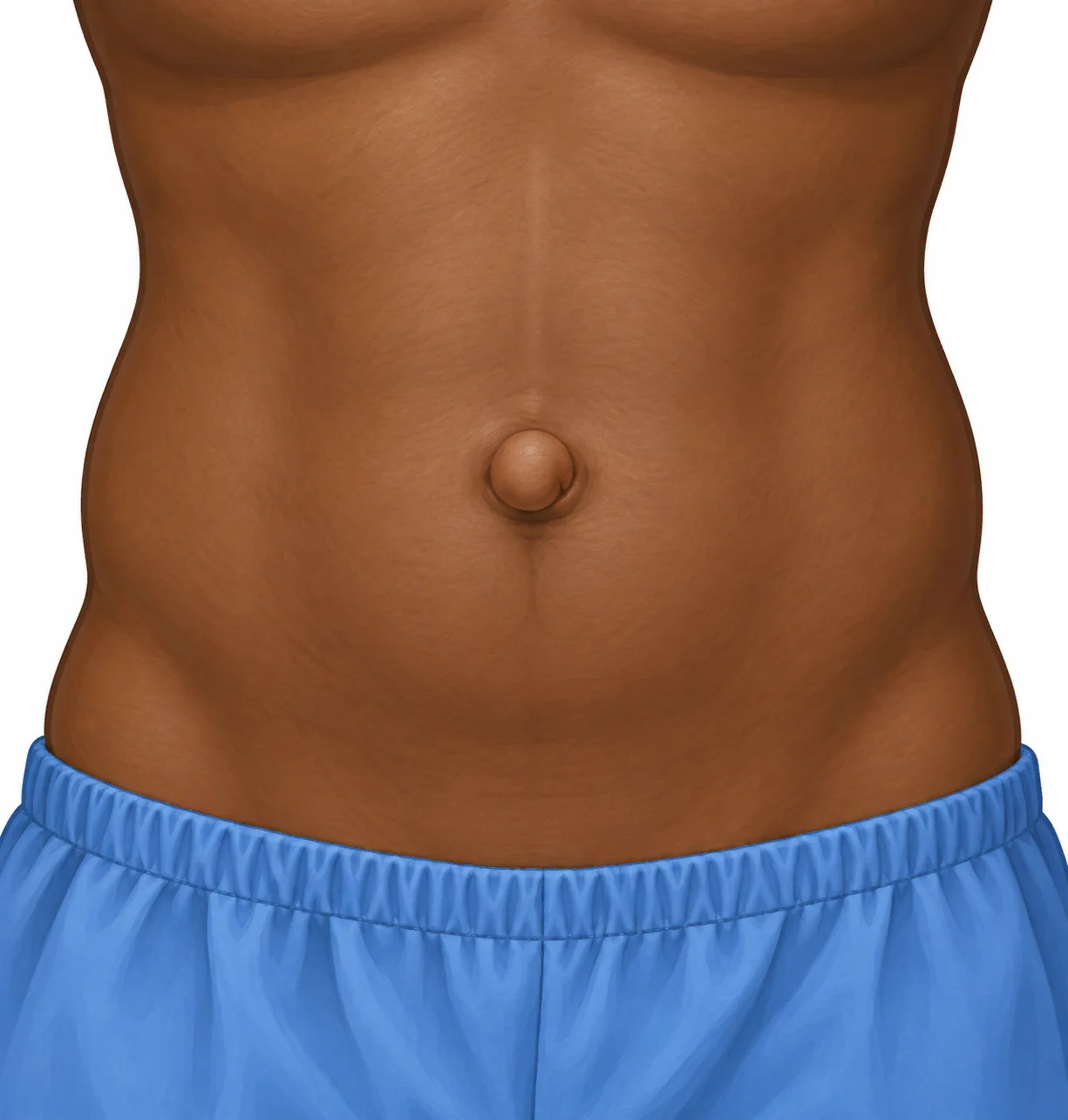 Illustration of an umbilical hernia with a bulge at the belly button.